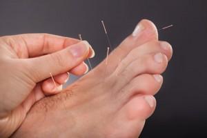 dry-needling