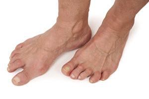 arthritis-in-the-feet