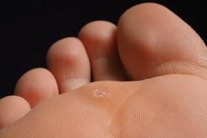 plantar-warts