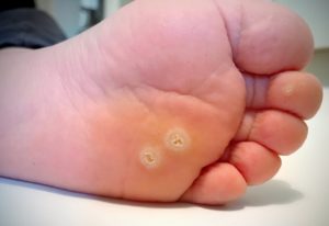 Plantar Warts