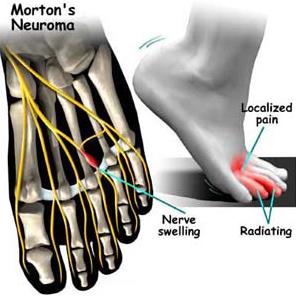 Mortons Neuroma